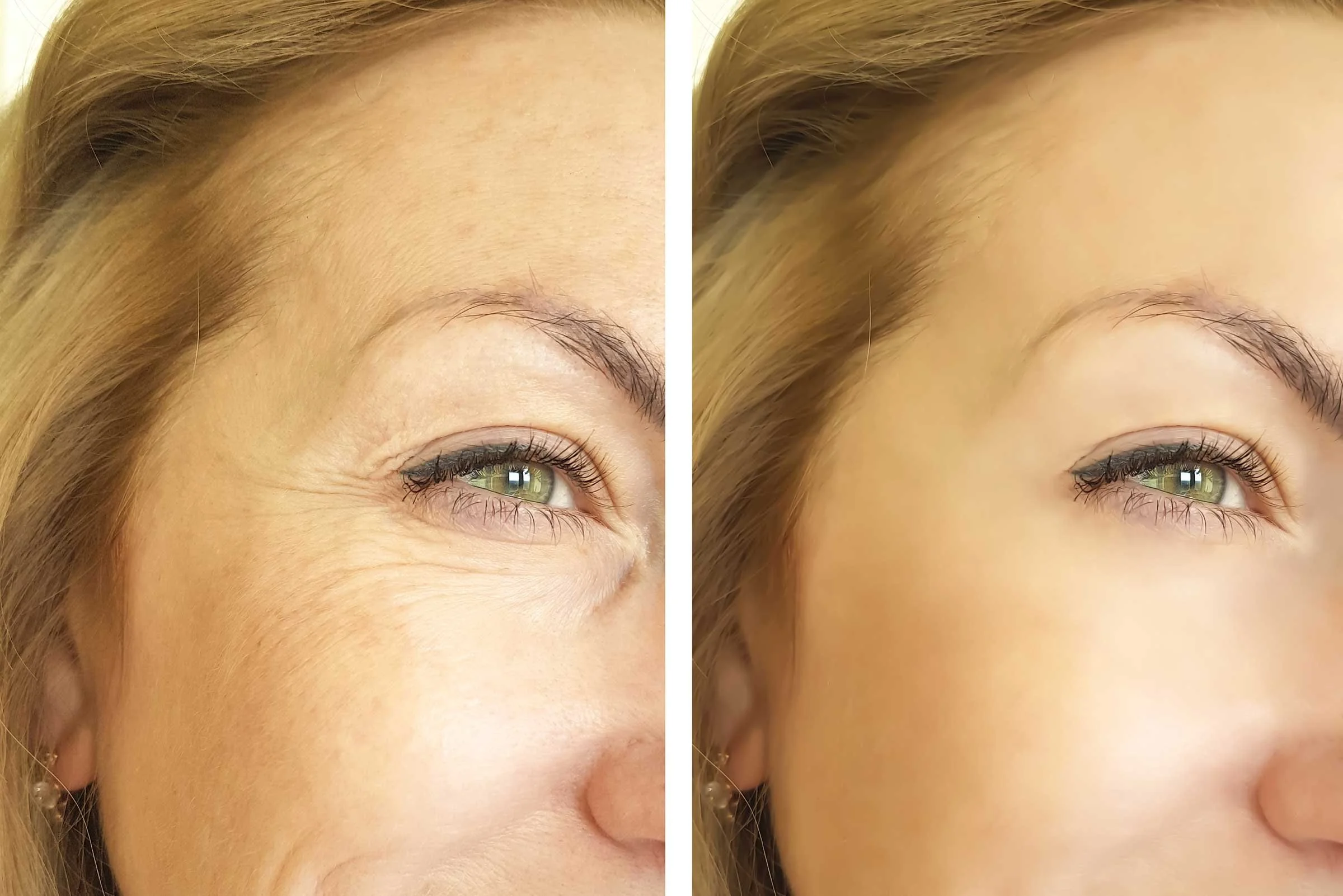 Before and after an anti-aging facial