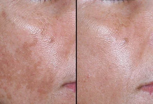 Before and after a chemical peel