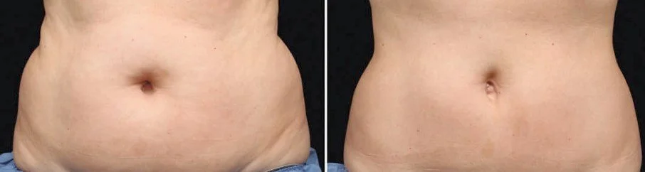 Before and after Cryo-Lean fat reduction
